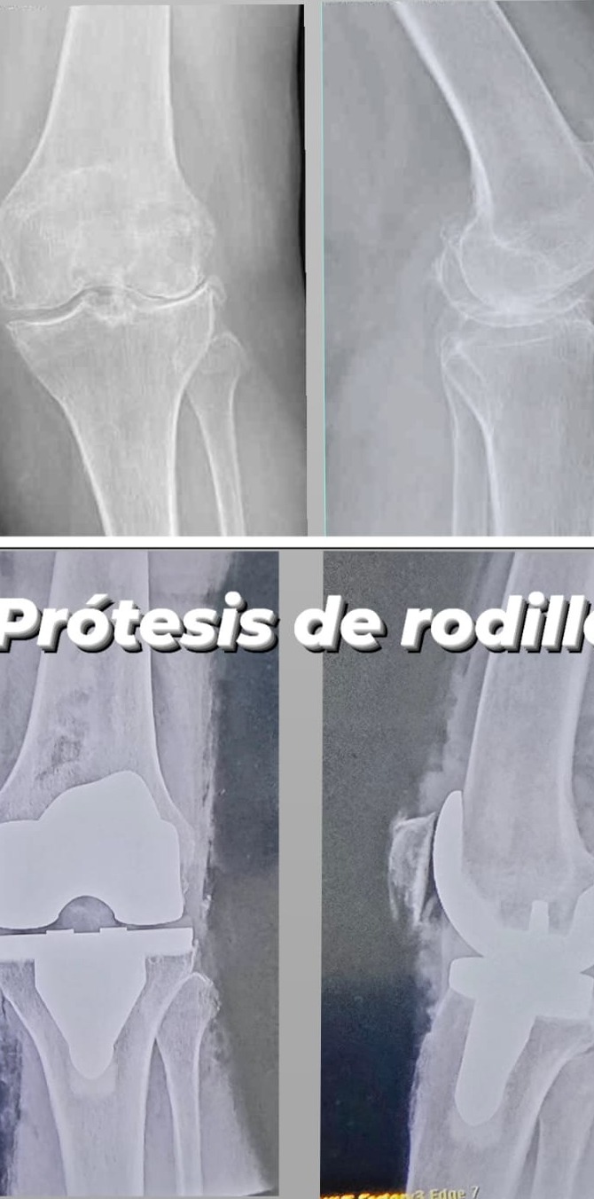 Antes y después de prótesis de rodilla