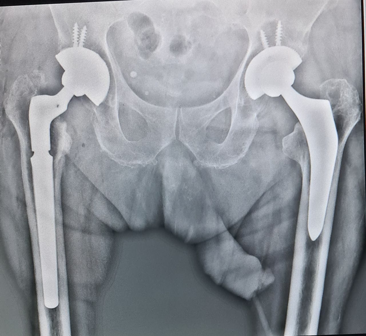 Radiografía de prótesis de cadera bilateral