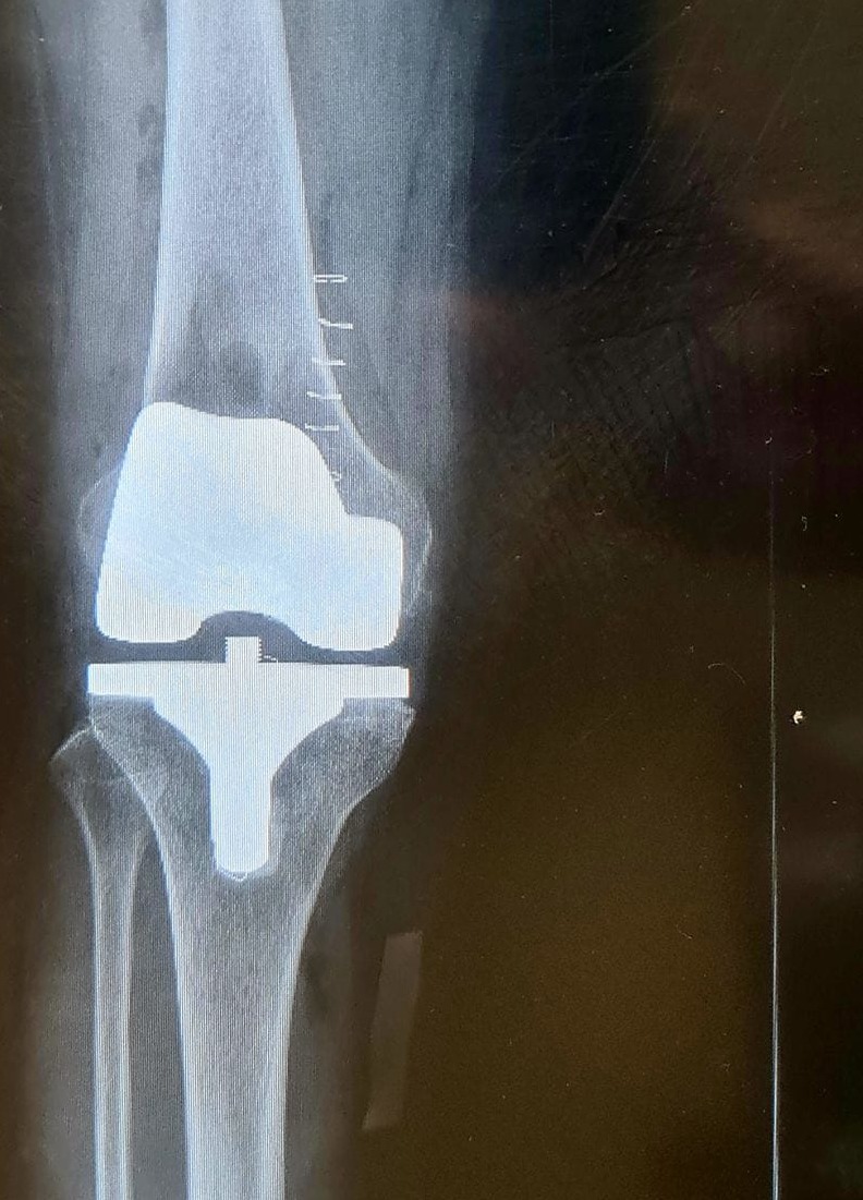 Radiografía de prótesis de rodilla